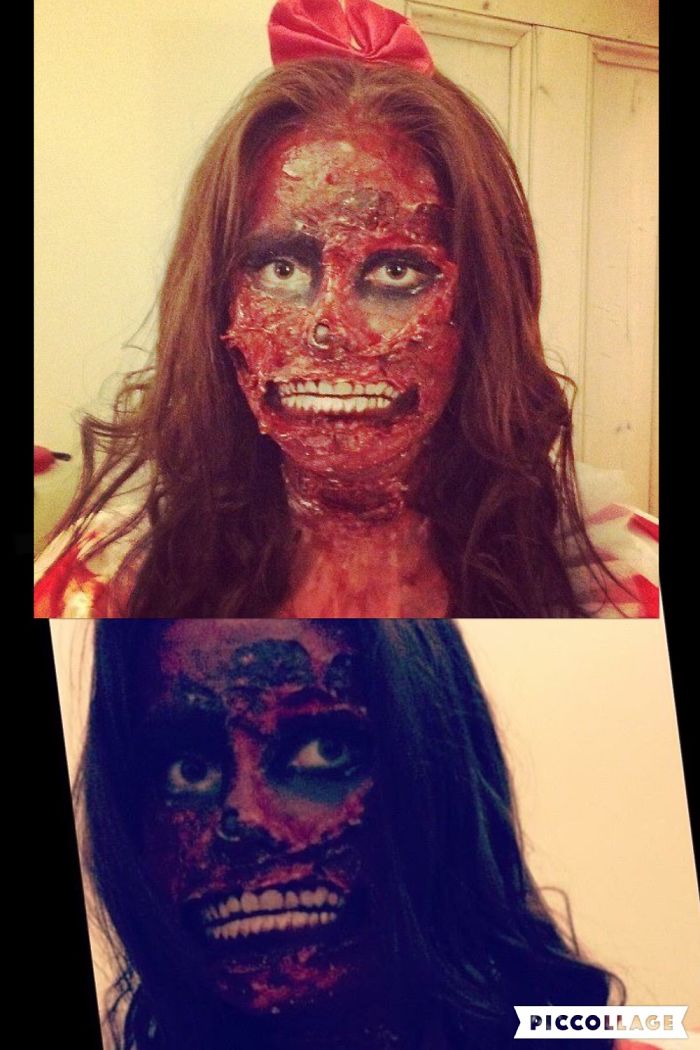 Burns Victim Snow White. I