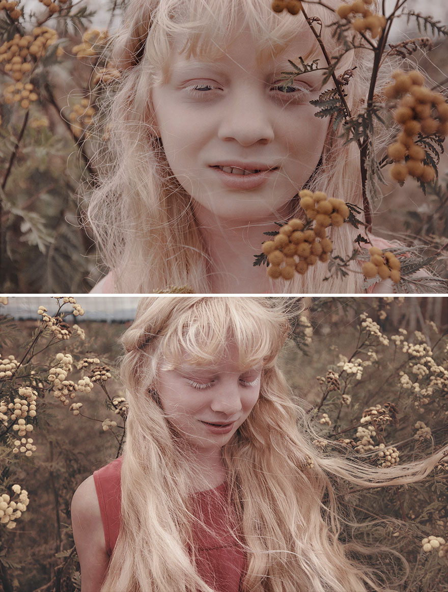 Beauty Of Albino Girl