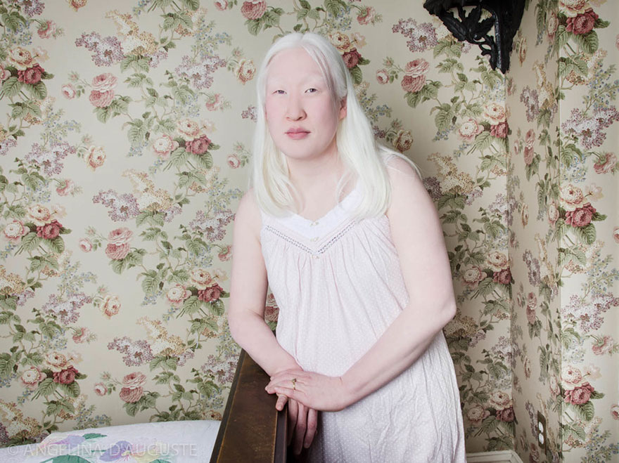 Albino Woman