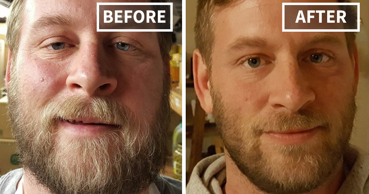 Before and after photos showing facial transformation and improved skin health from quitting drinking alcohol.