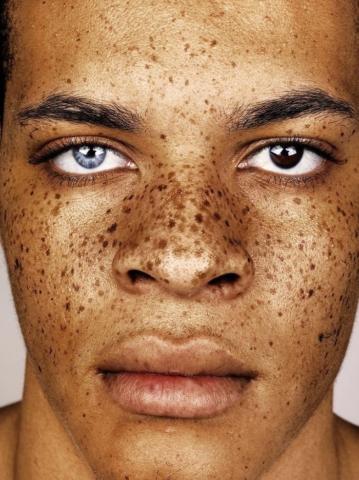 Beautiful Freckles