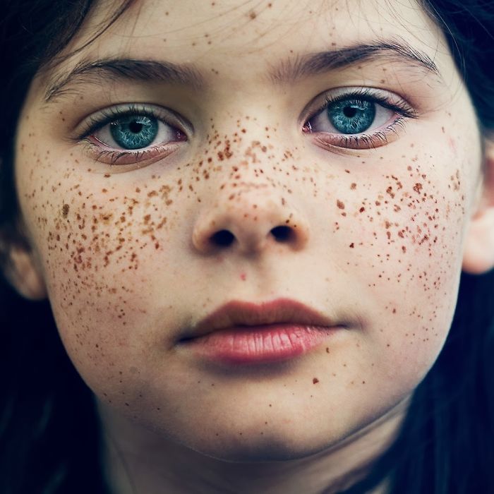Beautiful Freckles