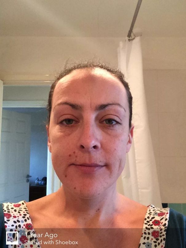 Woman showing skin changes and improved appearance in before-and-after pics of what happens when you stop drinking.