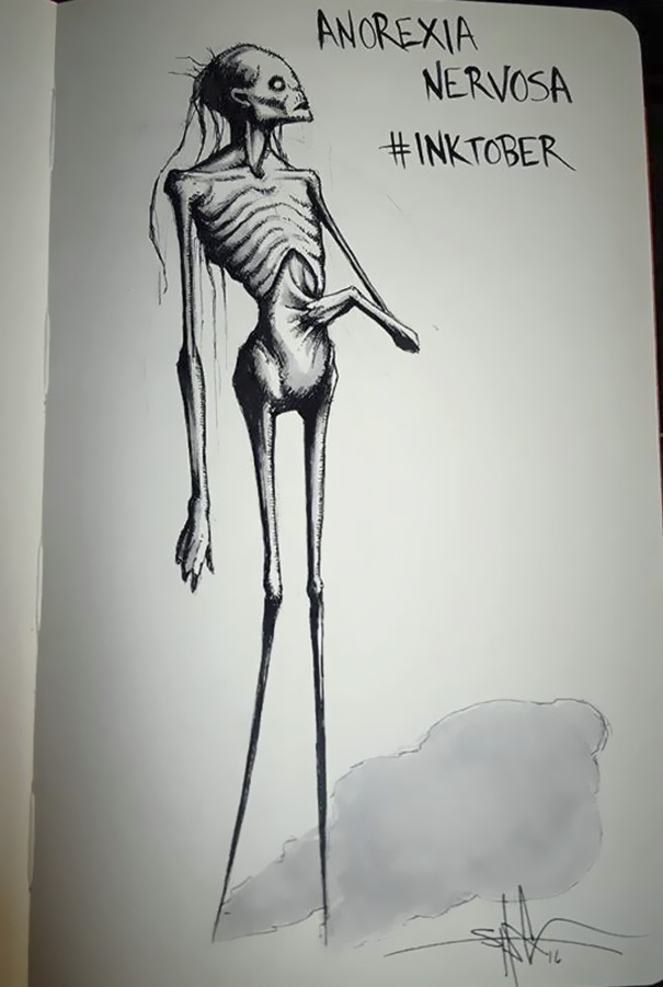 Anorexia Nervosa