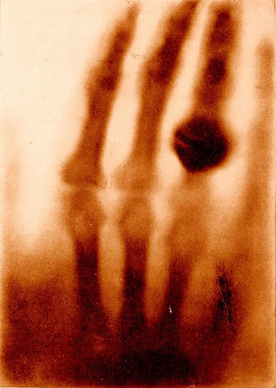 Historic X-ray of a hand, among the most famous photos, showing skeletal structure with a ring on the finger.
