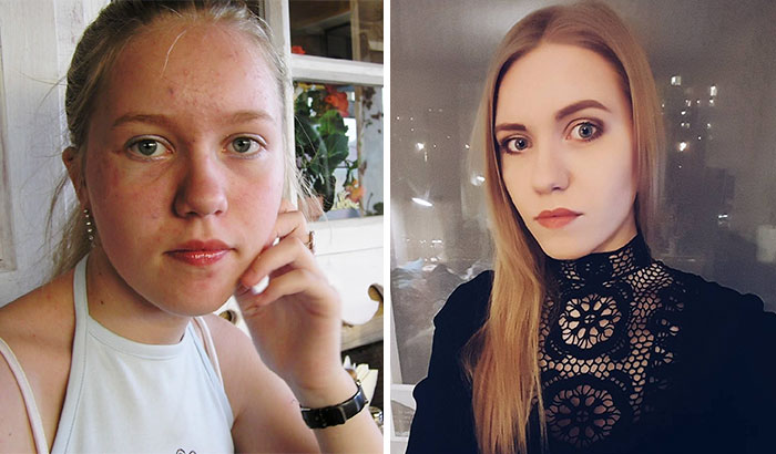 13 Years Old And Now, 24 Years Old. I Had Horrible Acne And Chubby Cheeks, Glad To See Them Gone. Also, Thumbs Up For Makeup!!!