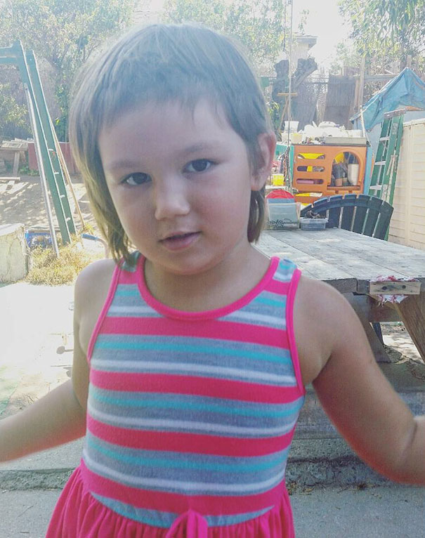 Child with self-cut hair in a striped dress, looking at the camera.