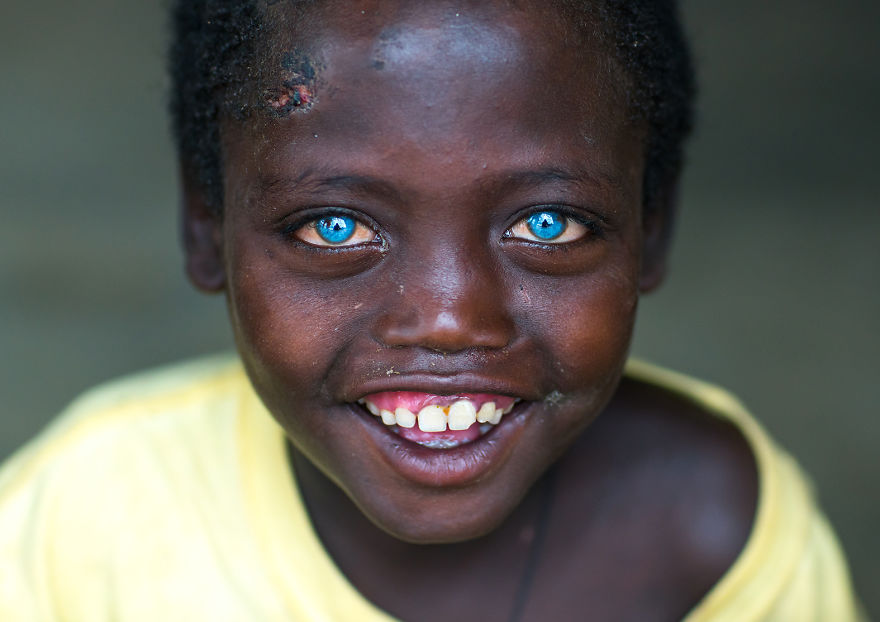 I Met Ethiopian Boy With The Plastic Eyes