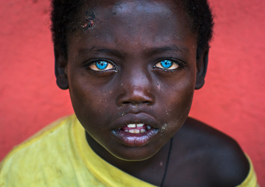 I Met Ethiopian Boy With The Plastic Eyes I Met Ethiopian Boy With The Plastic Eyes