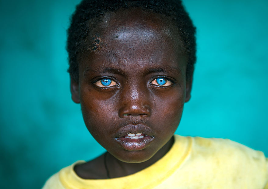 I Met Ethiopian Boy With The Plastic Eyes I Met Ethiopian Boy With The Plastic Eyes