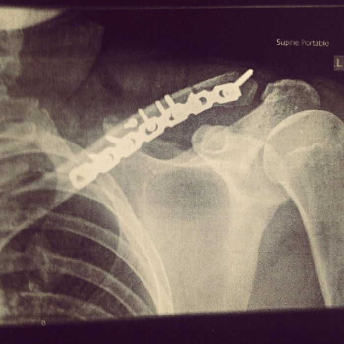 I Made A Ring Out Of The Metal Plate From My Surgery