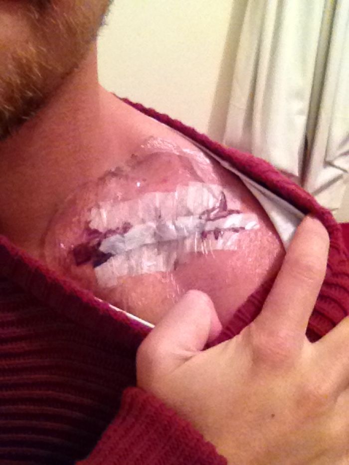 I Made A Ring Out Of The Metal Plate From My Surgery