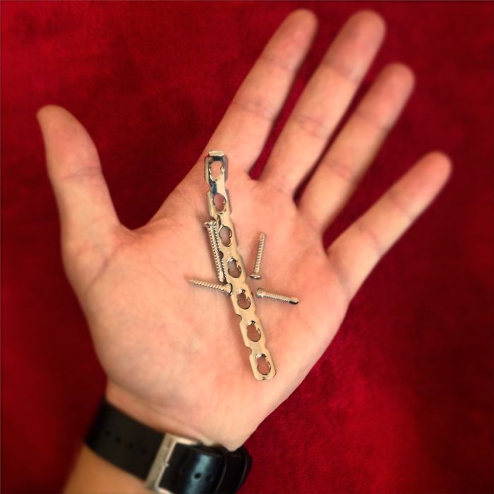 I Made A Ring Out Of The Metal Plate From My Surgery
