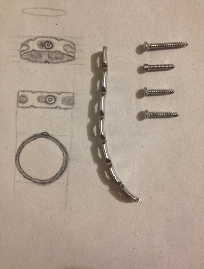 I Made A Ring Out Of The Metal Plate From My Surgery I Made A Ring Out Of The Metal Plate From My Surgery