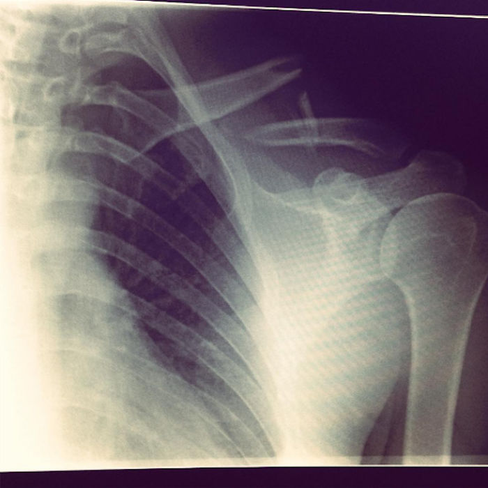 I Made A Ring Out Of The Metal Plate From My Surgery