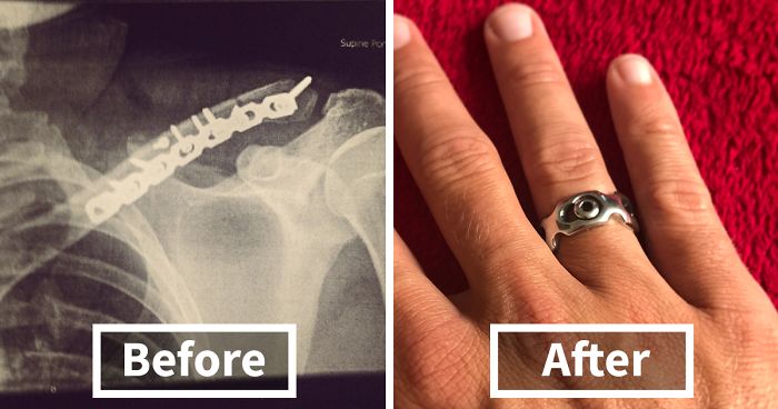 I Made A Ring Out Of The Metal Plate From My Surgery
