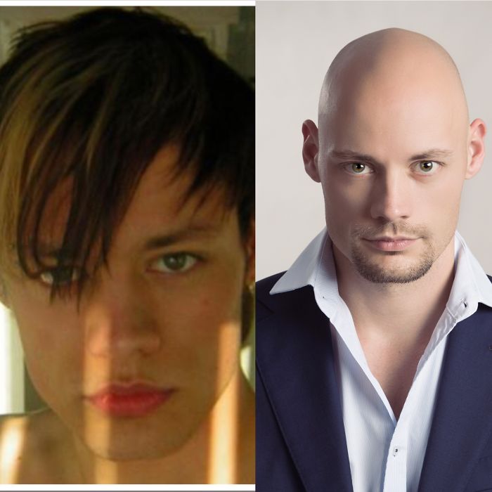 At 18 And 28. Lost My Hair, Gained A Clue.