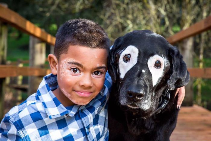 Boy With A Rare Skin Disorder Hates His Looks, Until He Meets His Dog Twin Boy With A Rare Skin Disorder Hates His Looks, Until He Meets His Dog Twin