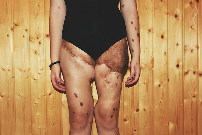 bullied-student-congenital-melanocytic-nevus-model-alba-parejo-1 bullied-student-congenital-melanocytic-nevus-model-alba-parejo-1