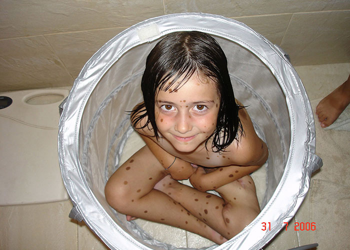 bullied-student-congenital-melanocytic-nevus-model-alba-parejo-10 bullied-student-congenital-melanocytic-nevus-model-alba-parejo-10