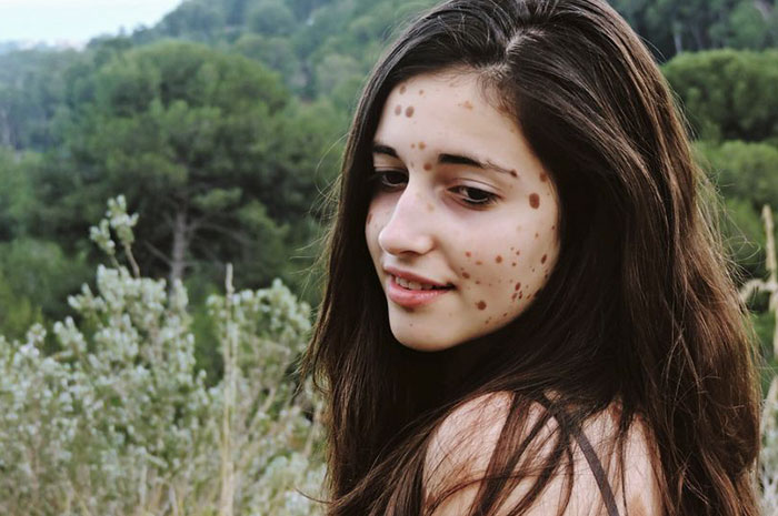 bullied-student-congenital-melanocytic-nevus-model-alba-parejo-2 bullied-student-congenital-melanocytic-nevus-model-alba-parejo-2