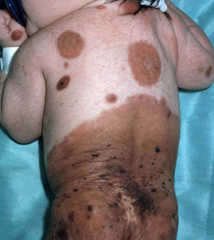 bullied-student-congenital-melanocytic-nevus-model-alba-parejo-3 bullied-student-congenital-melanocytic-nevus-model-alba-parejo-3
