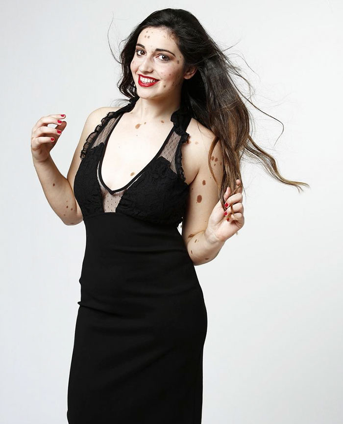 bullied-student-congenital-melanocytic-nevus-model-alba-parejo-7 bullied-student-congenital-melanocytic-nevus-model-alba-parejo-7