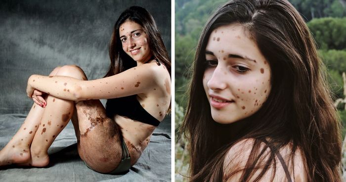 This Teen Was Brutally Bullied For Having Over 500 Birthmarks, But Look At Her Now