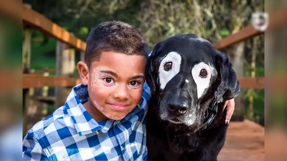 Boy With A Rare Skin Disorder Hates His Looks, Until He Meets His Dog Twin