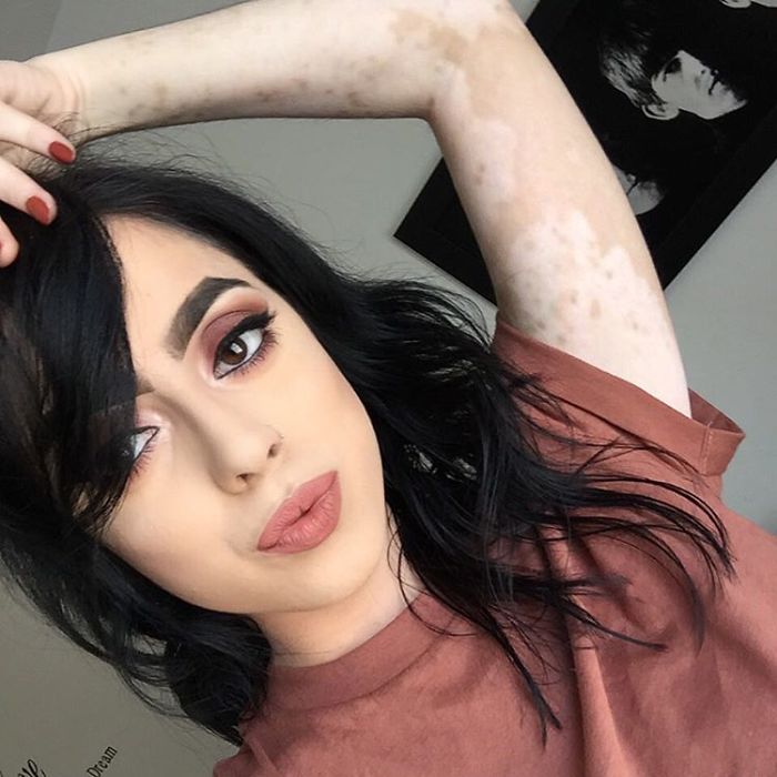 After Being Bullied For Vitiligo All Her Life, This Girl Now Turns Her Body Into Amazing Art After Being Bullied For Vitiligo All Her Life, This Girl Now Turns Her Body Into Amazing Art