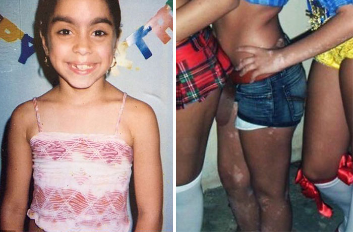 After Being Bullied For Vitiligo All Her Life, This Girl Now Turns Her Body Into Amazing Art After Being Bullied For Vitiligo All Her Life, This Girl Now Turns Her Body Into Amazing Art