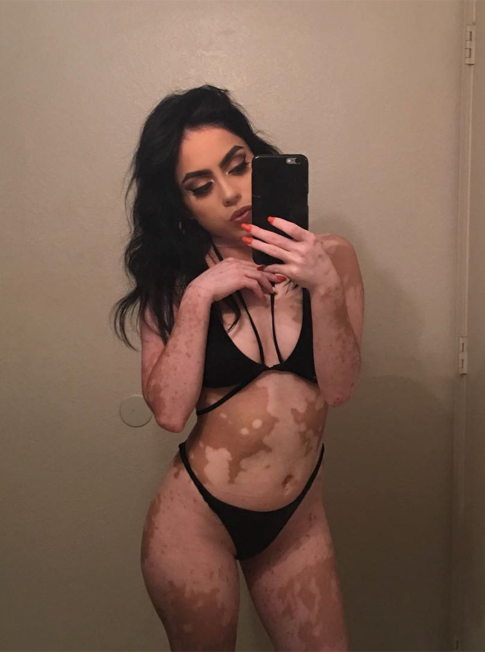 After Being Bullied For Vitiligo All Her Life, This Girl Now Turns Her Body Into Amazing Art After Being Bullied For Vitiligo All Her Life, This Girl Now Turns Her Body Into Amazing Art