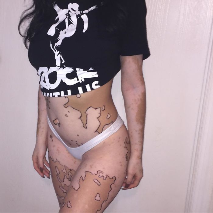 After Being Bullied For Vitiligo All Her Life, This Girl Now Turns Her Body Into Amazing Art After Being Bullied For Vitiligo All Her Life, This Girl Now Turns Her Body Into Amazing Art