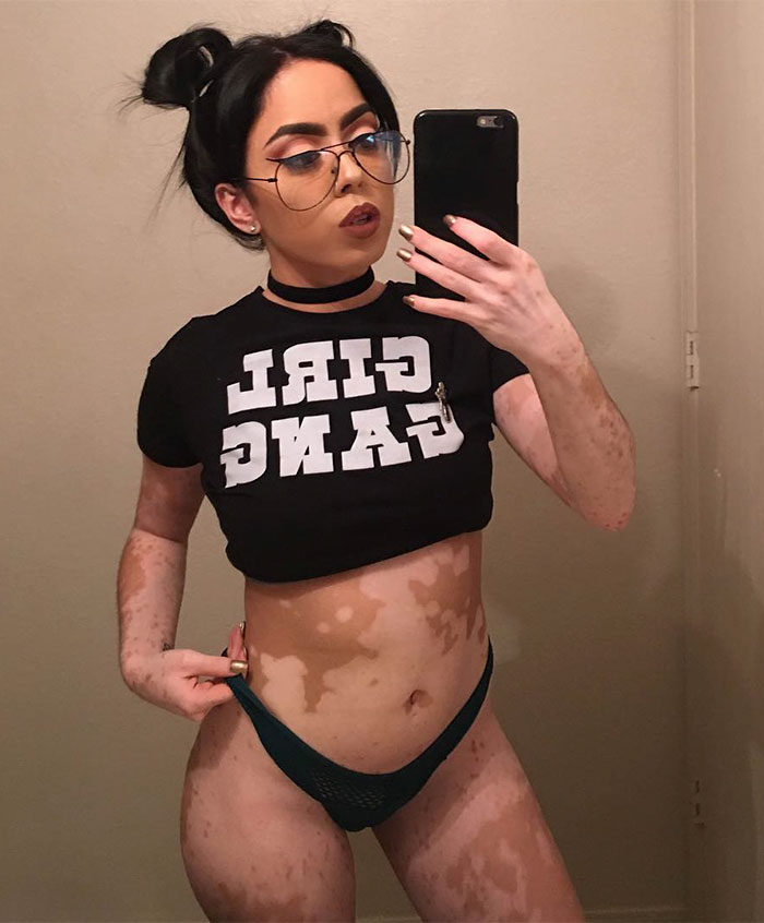 After Being Bullied For Vitiligo All Her Life, This Girl Now Turns Her Body Into Amazing Art After Being Bullied For Vitiligo All Her Life, This Girl Now Turns Her Body Into Amazing Art