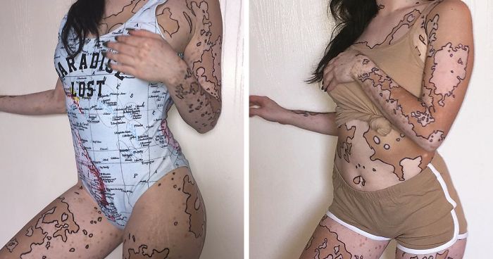 After Being Bullied For Vitiligo All Her Life, This Girl Now Turns Her Body Into Amazing Art