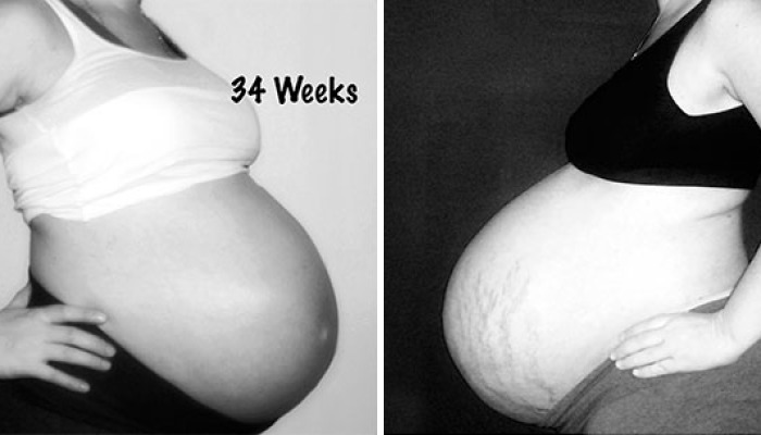 Side By Side Comparison Of My Singleton Pregnancy And My Twin Pregnancy