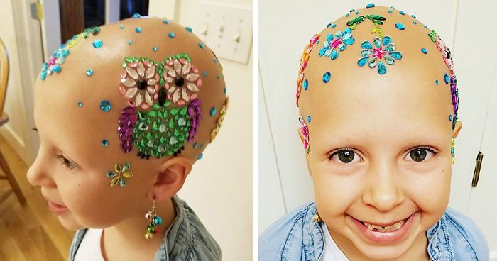 This 7-Year-Old Girl Didn’t Let Alopecia Stop Her From Dazzling Everyone At School On Crazy Hair Day
