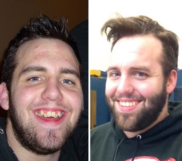 My Single Mother Couldn't Afford Braces For Us Growing Up. So When I Got A Job, I Saved And Paid For Them Myself. Most Fulfilling Decision I've Ever Made