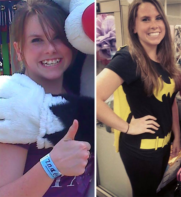 Never Underestimate The Power Of Braces