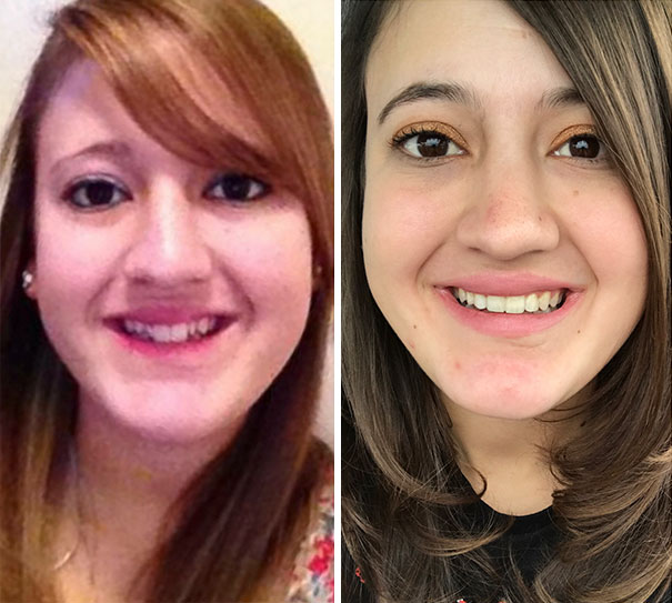 Before And After Braces