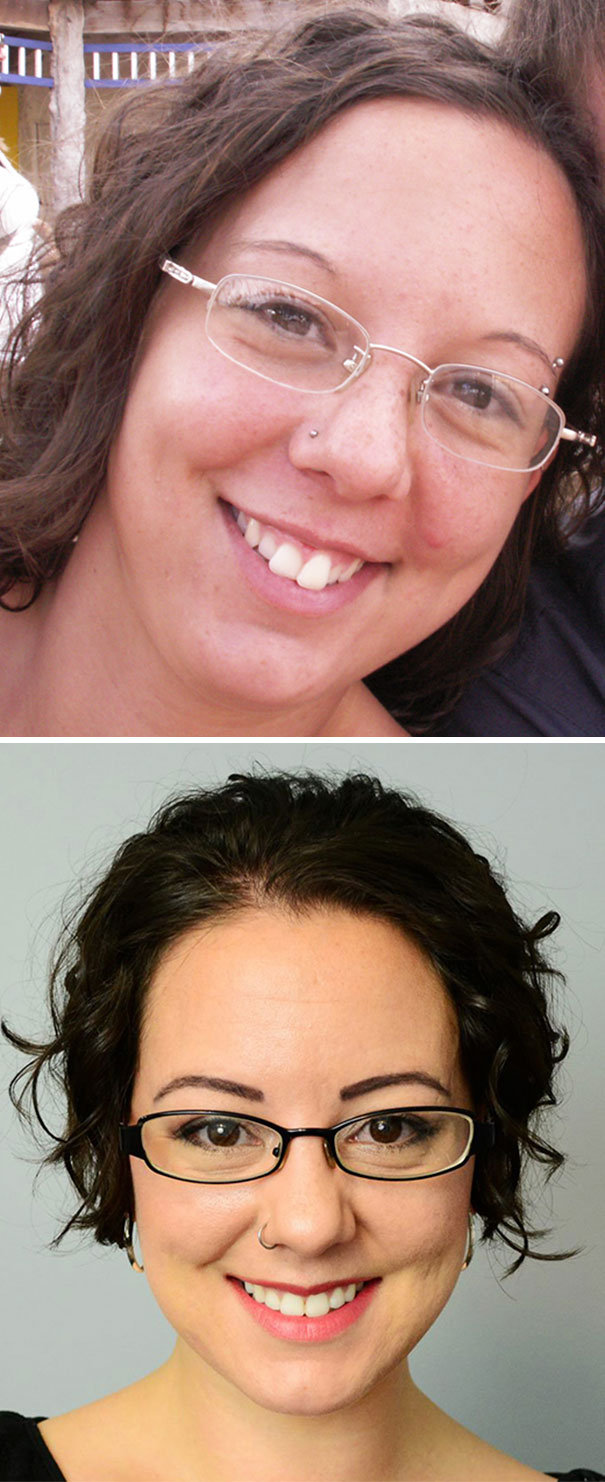 Hopefully A Little Encouragement For Anyone Thinking Of Braces/jaw Surgery