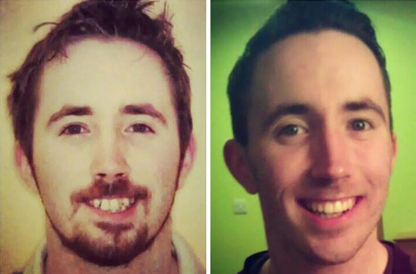 A Reason To Smile: Getting My Braces As A 25 Year Old