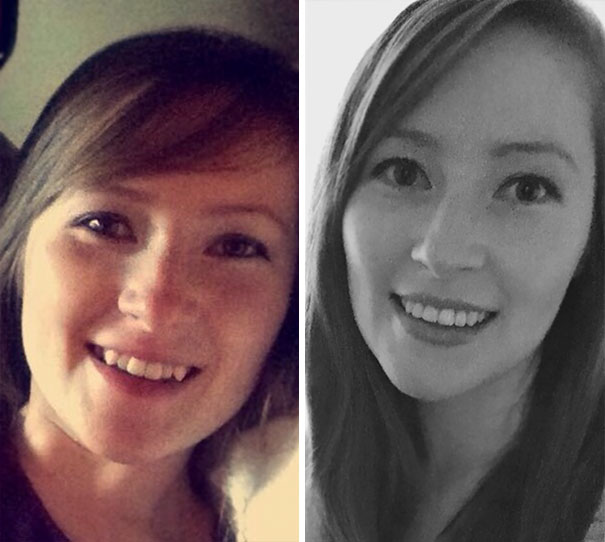 14 Months Of Treatment And I'm Done!