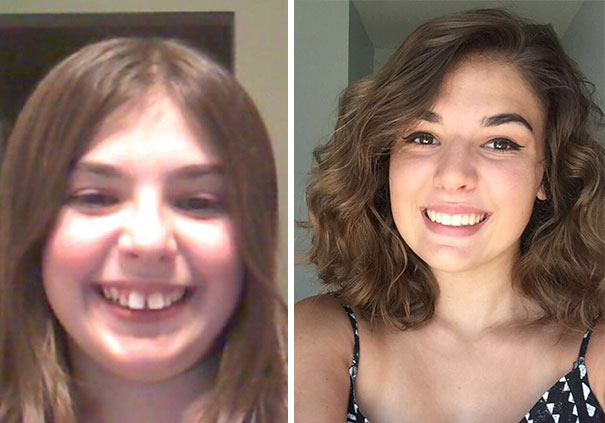 Let's Thank God For Braces