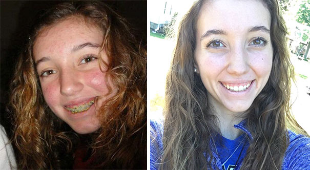 4 Years Ago Today I Got My Braces Off
