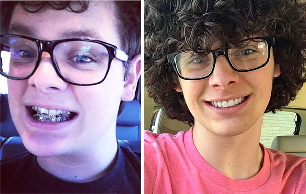 Praise Jesus For This Transformation! From The First Day Of Braces To When I Finally Got Them Off