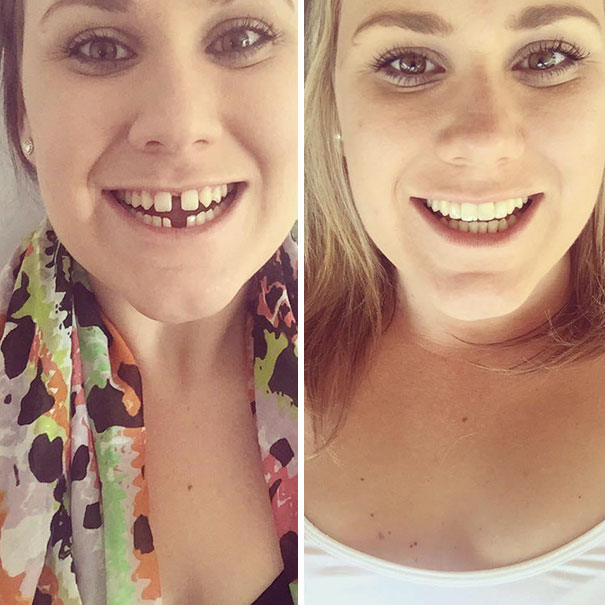 Smile Transformation