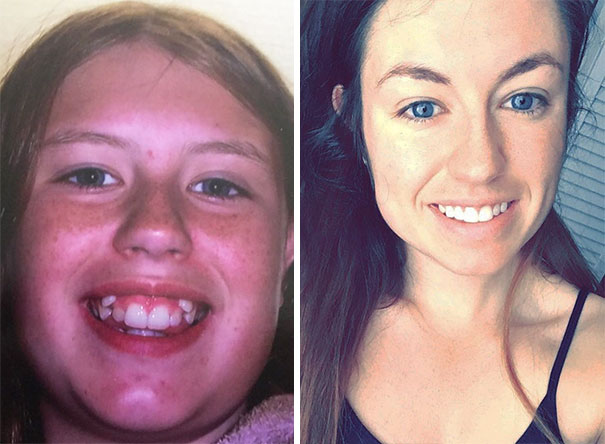 Pre-Braces Fave Vs Now