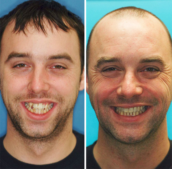 Smile Transformation