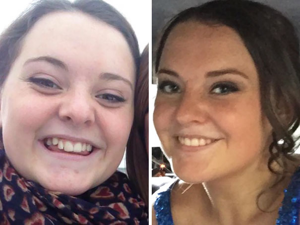 I Got My Braces Off Yesterday And The Difference Is Crazy